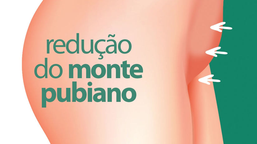 Redução de Monte Pubiano